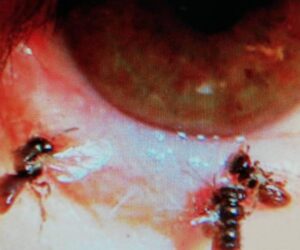 Doc Finds Bees Live In Woman’s Eye