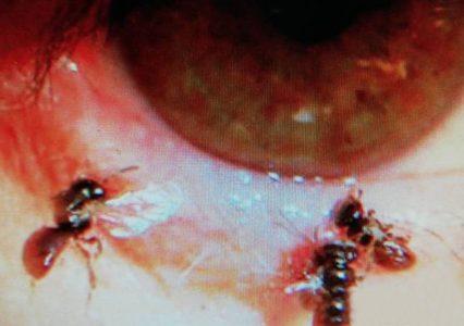 Read more about the article Doc Finds Bees Live In Woman’s Eye