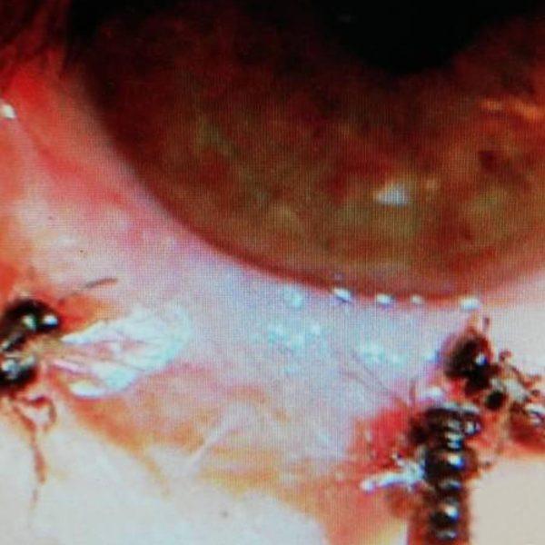 Doc Finds Bees Live In Woman’s Eye