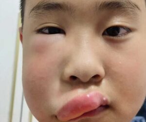 Young Boy’s Face Swells After Being Repeatedly Stung By Bees