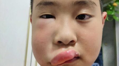 Read more about the article Young Boy’s Face Swells After Being Repeatedly Stung By Bees